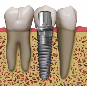 Marrero Tooth Implants